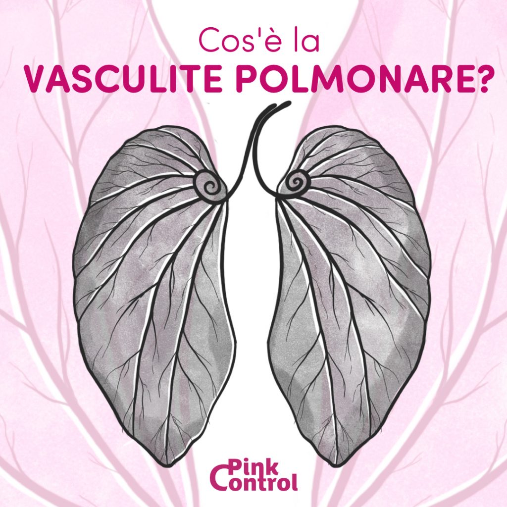 Vasculite Polmonare